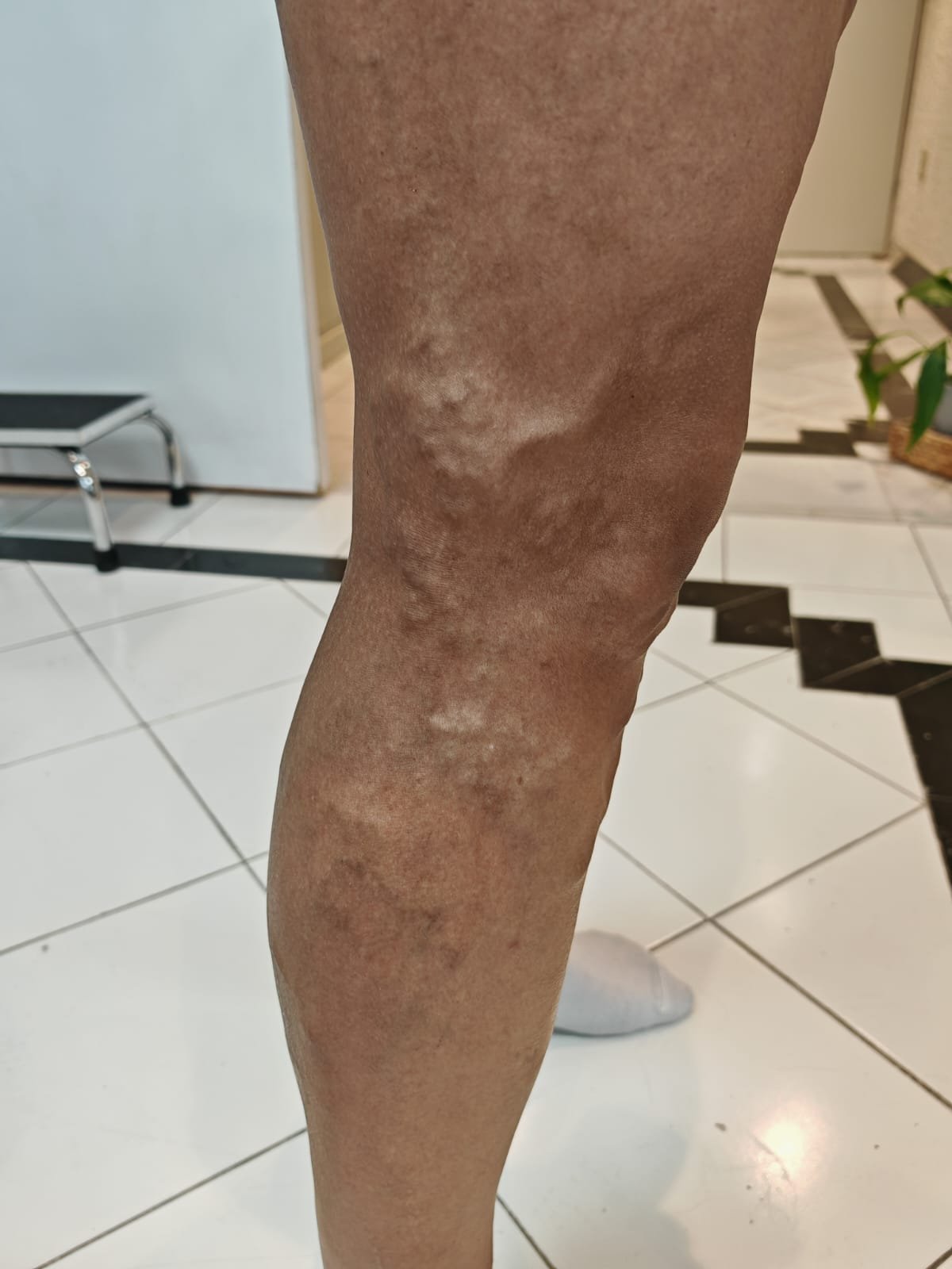 Caso 1 antes del tratamiento